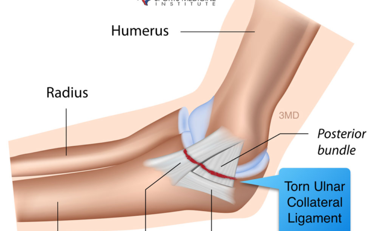 Comprehensive Guide to Tommy John Surgery: Ulnar Collateral Ligament Reconstruction