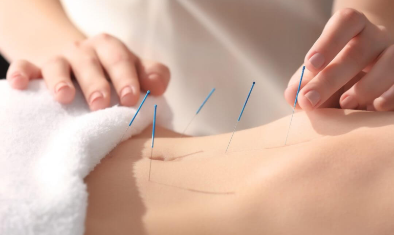 Unveiling the Truth About Acupuncture