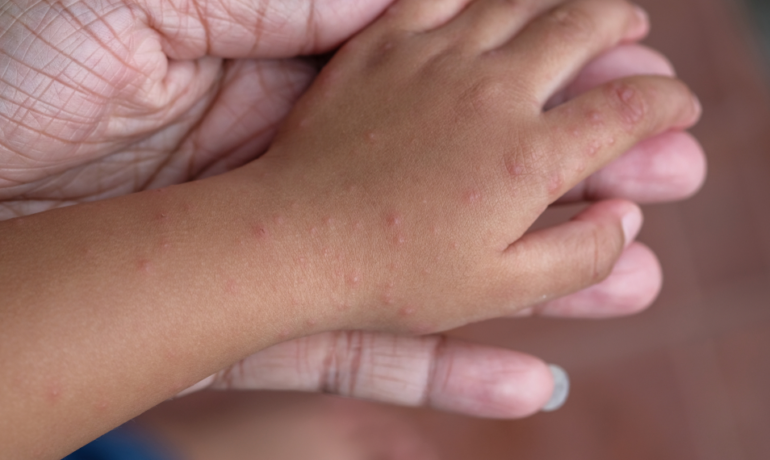 Hand-Foot-and-Mouth Disease: A Comprehensive Guide